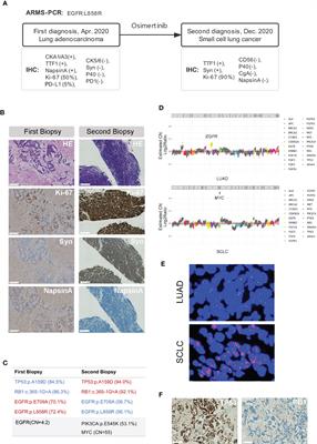 Case report: TP53 and RB1 loss may facilitate the transformation from lung adenocarcinoma to small cell lung cancer by expressing neuroendocrine markers